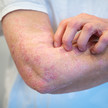 Foto: Eine Person hat gerötete, schuppende Stellen am Arm.