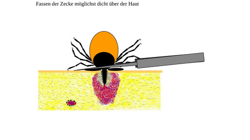 160614 zecke entfernung2 lglbayern