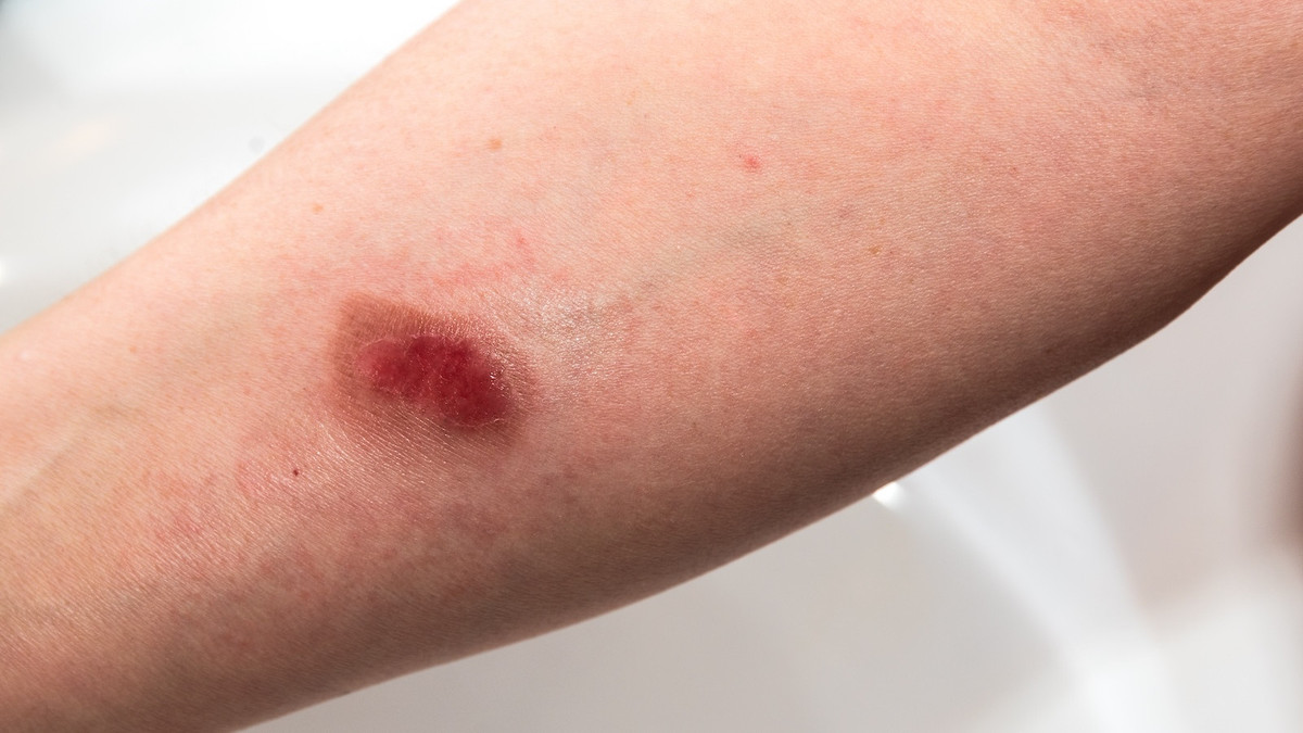 Wundbehandlung-Erstattung-bis-Ende-2026