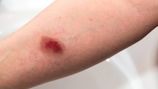 Symbolbild: Arm mit Brandwunde