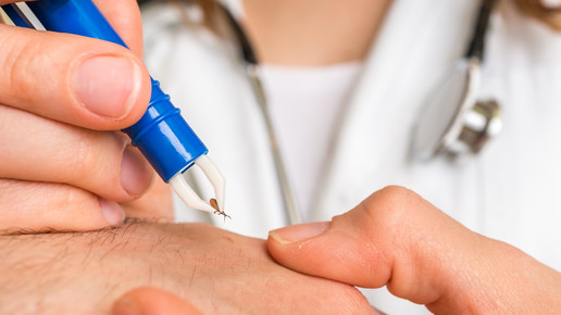 Foto: Eine Ärztin entfernt eine Zecke bei einem Patienten.