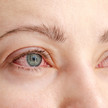Bindehautentzündung: Tipps für die Beratung