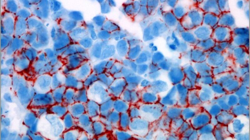 FDA: Zulassung für Trastuzumab-Biosimilar