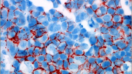 Mikroskopisches Bild einer Metastase