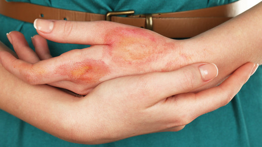 Erste Hilfe bei Verbrennungen