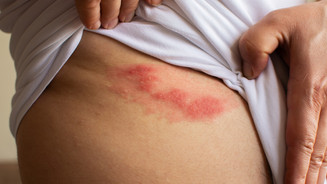 Unterschiede bei Gürtelrose-Impfungen