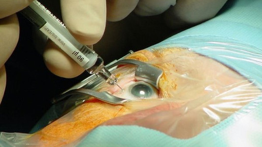 makula Universita  tsaugenklinik Ulm Prof Lang