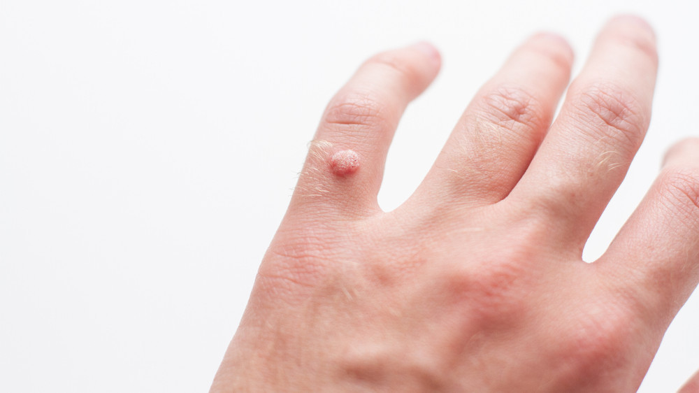 Warzen Lästig, aber meist harmlos APOTHEKE ADHOC