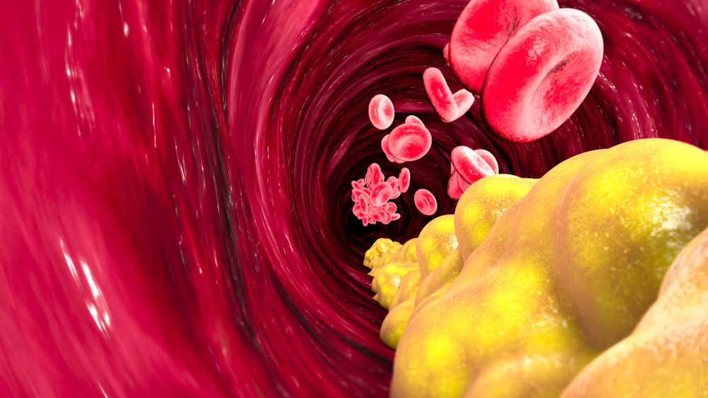 Cholesterin-Per-Infusion-LDL-dauerhaft-senken-