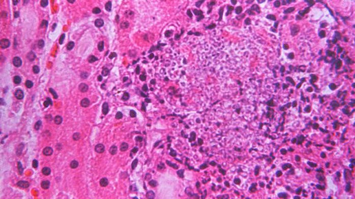 Mehr Patienten mit gefährlichem Hefepilz