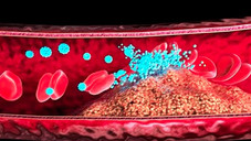 Nanopartikel lösen Blutgerinnsel auf