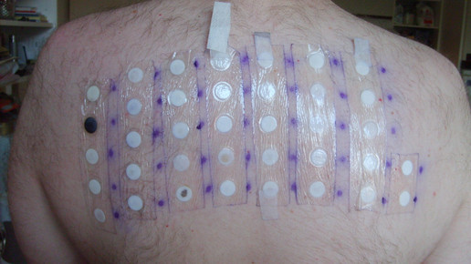 Kein Solarium vor Allergietest