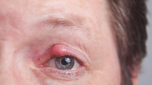 Gerstenkorn: Achtung, ansteckend!