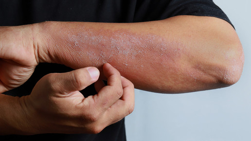 Mann kratzt sich am Arm wegen Entzündung und Hautausschlag durch Corona-Infektion.