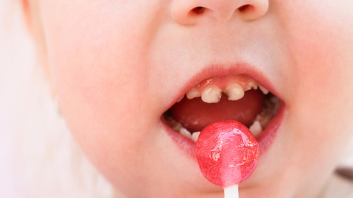 Jedes dritte Kind hat Karies