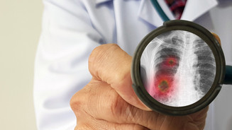 Lungenkrebs: Soforttherapie mit Sevabertinib Lungenkrebs: Soforttherapie mit Sevabertinib