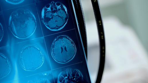 Covid-19: Neurologische Symptome und Komplikationen