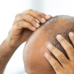 Warentest: Haarwuchsmittel können Kahlschlag nur verzögern