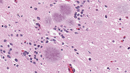 Creutzfeldt-Jakob: Neue Variante entdeckt