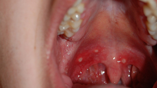 aphthen wikifrei rudolfschreier 