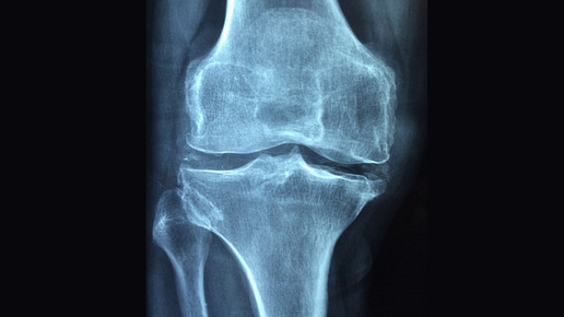 Patienten-Erinnerungskarte für Pamidronsäure