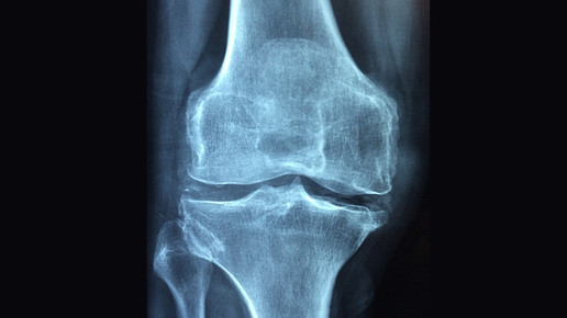 knie knochen roentgen pixabay