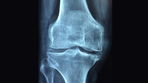 Patient bekommt gezüchtetes Knochengewebe
