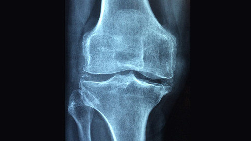 knie knochen roentgen pixabay