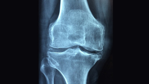 Burosumab bei Phosphatdiabetes