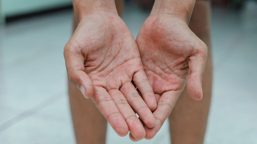 Todesfälle nach Impfung: EMA prüft Ixchiq