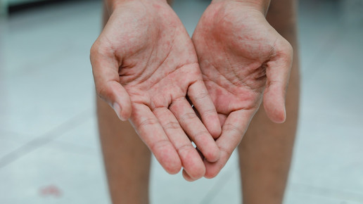 Hände einer mit Chikungunya infizierten Person