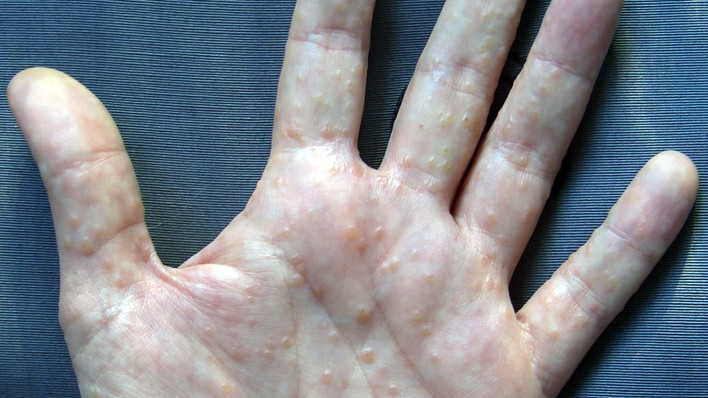 Dyshidrosis Kleine Bläschen Stress Ekzem Hand www.apotheke-adhoc.de