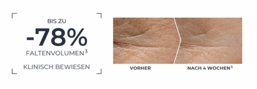 Vorher-Nachher-Vergleich von Hautfalten nach 4 Wochen mit der Aufschrift bis zu -78 % Faltenvolumen.