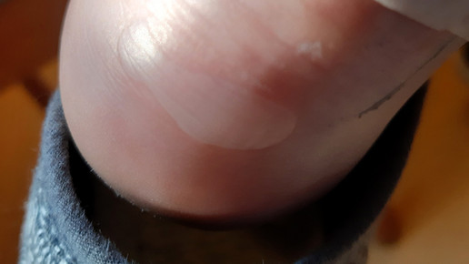 Fünf Tipps gegen Fußblasen