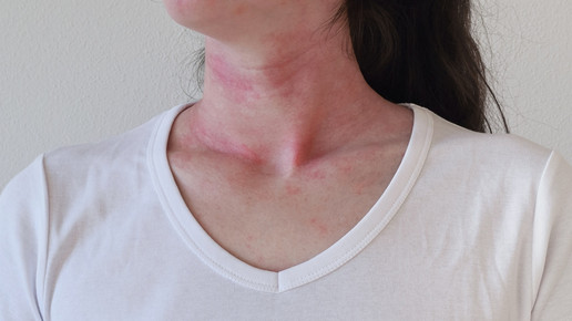 Akute Ekzeme: Welche Topika wann empfehlen?