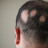 Kreisrunder Haarausfall: Neue Therapieoption in der Pipeline