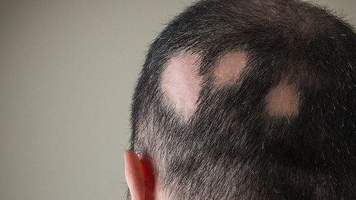 Kreisrunder Haarausfall: Neue Therapieoption in der Pipeline