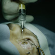 Susvimo: Ranibizumab als Implantat Spritze wird ins Auge gesetzt