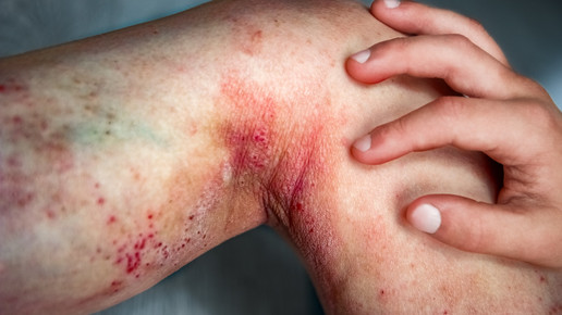 Lebrikizumab für Atopische Dermatitis zugelassen