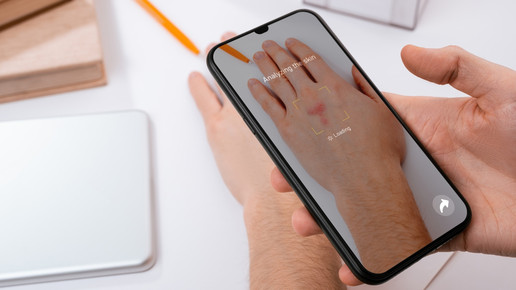 XAI stärkt Vertrauen in Melanomdiagnostik