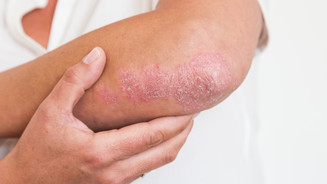 Foto: Schuppenflechte (Psoriasis) am Ellbogen