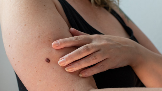 Hautkrebs: Therapieansatz gegen Metastasenbildung