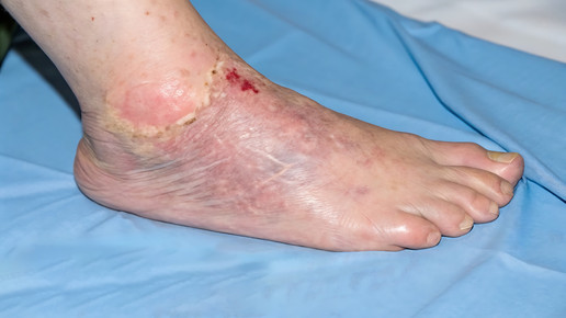 Wundbehandlung: UrgoStart Tül ist erstattungsfähig