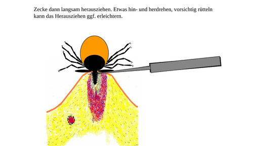 160614 zecke entfernung3 lglbayern