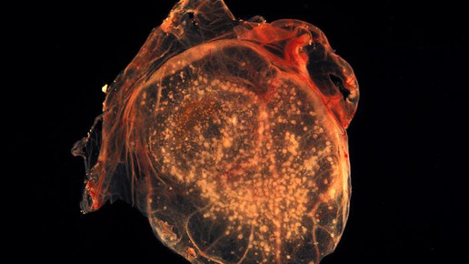 pocken 2542 dr david kirsh cdc