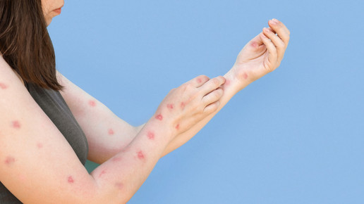 Symbolbild: Mpox-Infizierte Frau 