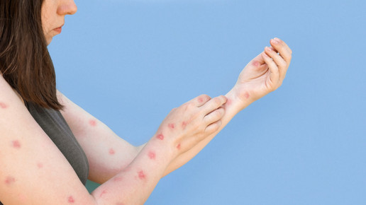 Mpox-Fälle 2025 nähern sich jetzt schon Vorjahresstand