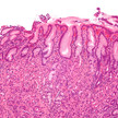 gastritis wiki nephron ccbysa30 Gastritis: Auf Anzeichen achten