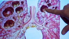 Der langwierige Kampf gegen Tuberkulose