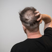 Doppelherz: Minoxidil zum Kampfpreis Mann von hinten der sich mit der Hand an seinen Hinterkopf fasst. Die Haare sind dünn, die Kopfhaut scheint durch.